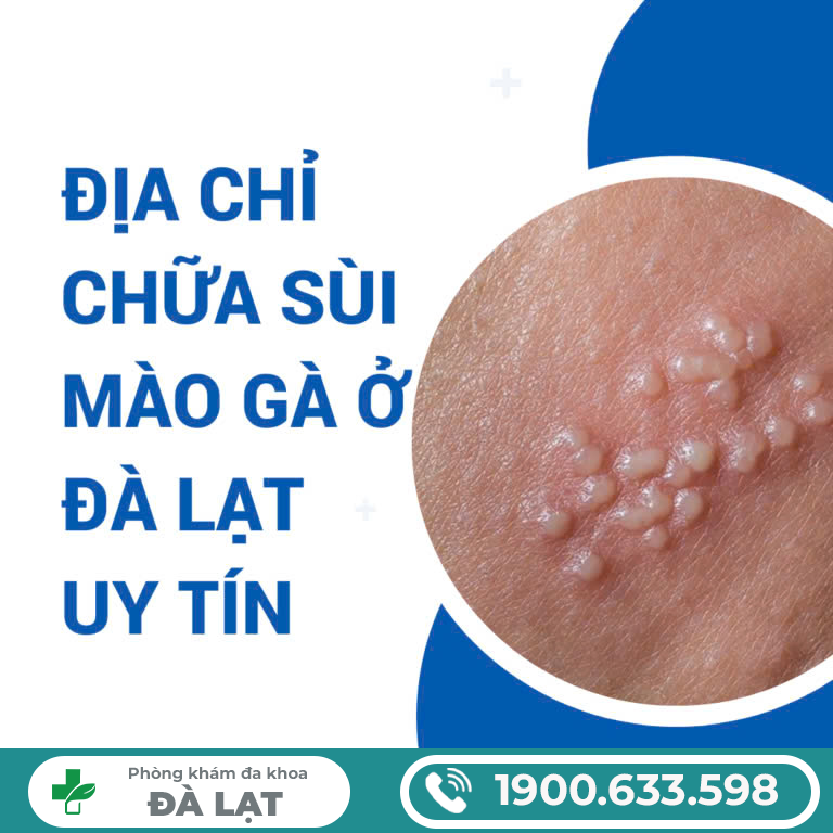 Bệnh sùi mào gà ở lỗ sáo là gì ? Nguyên nhân , dấu hiệu cách điều trị bệnh sùi mào gà ở lỗ sáo 